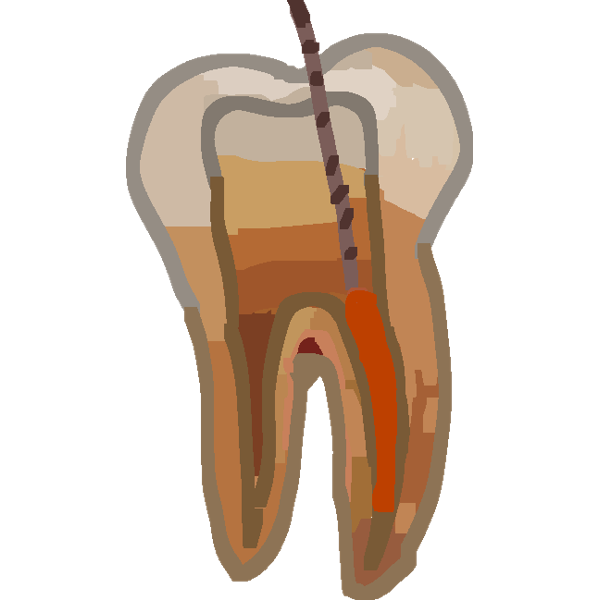 A tooth getting a root canal